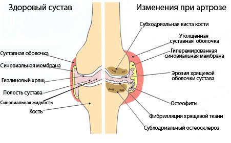NSP для суставов в Молдове купить