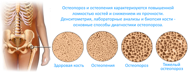 Остеопороз NSP
