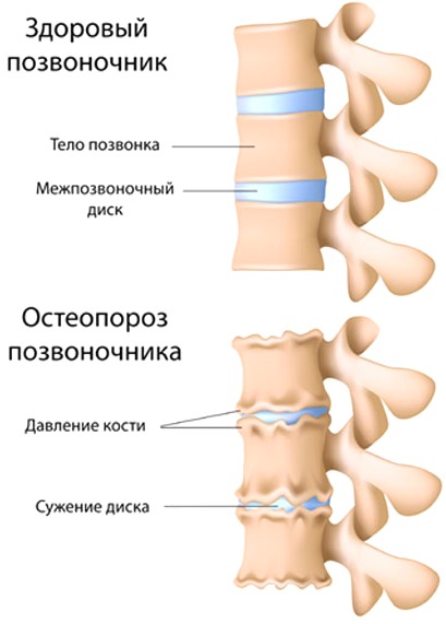 Здоровый позвоночник