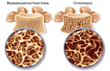 Кальций улучшит состояние костной структуры