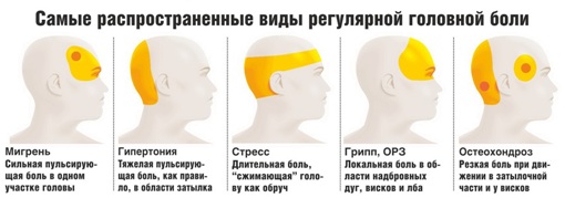 Самые распространенные виды головной боли